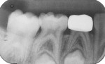 Postoperative radiograph of crown after 46 months.