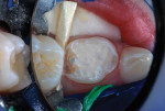 Occlusal reduction completed.