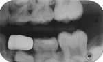 Postoperative radiograph after 33 months