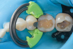 Separation ring in place, which intimately adapts the matrix to the tooth. The mesial wall of tooth No. 30 was built up to convert the Class II restoration into a Class I.
