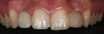 Preoperative photograph of the patient showing reduction of the proximal surfaces of teeth Nos. 6, 8, 9, and 11 and the denture teeth bonded to fill the edentulous maxillary anterior lateral incisor sites.