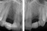 The clinical radiographs reveal sufficient
spacing for dental implants; however, the patient’s age was a major concern for that restorative option.