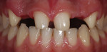Teeth Nos. 6, 8, 9, and 11 were prepared for the placement of two FPDs.