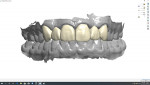 The technician superimposed the final virtual smile design onto the scan of the preparations to design and fabricate both the provisional and final restorations.