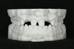 A 3D-printed model was ordered to test the fit of the final ceramic restorations and assist in the final contouring.