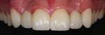 The highly esthetic final restorations seated in the mouth.