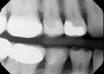Preoperative radiograph underscoring the need for a new restoration.