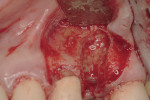 Figure 2  Extraction socket of a fractured maxillary premolar after debridement.