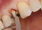 Complete, effective retraction of the gingiva through laser troughing.