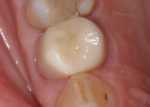 The final restoration exhibiting margins that are slightly subgingival to promote periodontal health.