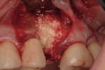 Figure 3  Bone allograft (FDBA) used to obdurate a debrided extraction socket.