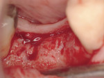 Figure 7  Re-entry of the grafted extraction socket at 3.5 months.