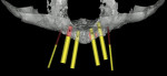 Figure 8  Digital treatment planning for the placement of four maxillary implants into a severely atrophic ridge. The planned implants are visualized, as well as the two fixation screws, which will stabilize the guide during surgery. (Photograph cour