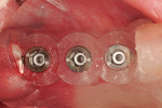 Figure 10  Implant-placement mounts through the stereolithic guide (Facilitate™, Astra Tech, <a target=