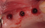 Figure 11  Removal of the surgical guide revealing flapless implant insertion.