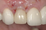 Figure 12  Screw-retained provisional crown on immediate implant in site No. 7. Placed the same day as extraction, implant placement, and bone augmentation. (Restoration by Dr. Brian Wilk).