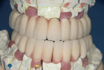 Figure 18  All-porcelain-bonded-to-zirconia restorations for full-mouth, implant-supported restoration.