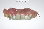 Fig 2. Digital smile design was completed in software and overlaid with the intraoral scan.
