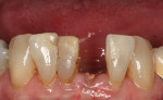 Fig 8. Pretreatment occlusal view. Lower left central incisor was fractured at the gumline. The patient was asymptomatic.