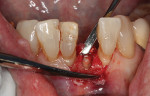Fig 9. The tooth root was reduced to slightly below the level of the bone.