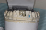 Fig 11. Frontal view of completed RBFPD on mandibular cast.
