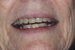 Fig 12. Completed RBFPD with patient smiling.
