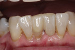 Fig 13. RBFPD after being in function for 13 months, with composite restoration on the lower right lateral incisor refinished.