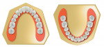 Fig 4. Symmetry from the midline and sufficient antero-posterior implant distribution allows for optimal distribution of forces throughout the arch and even loading of implants.