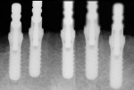 Fig 18. Adjacent radiographs showed the parallelism among five of the six implants and verified adequate interimplant distance between them. (Position of the sixth implant was verified clinically, as a very shallow lingual vestibule prevented adequate positioning of the sensor.)