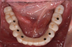 Fig 19. As a result of the accurate positioning and guidance of the implant drill, a screw-retained provisional restoration was able to be delivered.