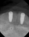 Fig 16. Radiograph immediately post–implant placement. Note parallelism of the two implants.