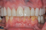 Fig 3. Treatment included nonsurgical periodontal therapy followed by placement of a fixed framework-supported provisional from Nos. 3 through 14.