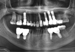 Fig 10. The final case was completed as single crowns in the maxillary jaw with a mesial cantilever No. 10 connected to No. 11 and single crowns at Nos. 29 and 30. Fig 10 shows a post-treatment panoramic radiograph. Fig 11 and Fig 12 show the completed case at 1 year post-treatment. Fig 13 shows a radiograph 1 year post-treatment. A nightguard was delivered with the final case to protect the investment (periodontal therapy: Robert A. Levine, DDS; restorative therapy: Zola Makrauer, DMD).