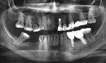 Fig 1. A 62-year-old healthy nonsmoking woman had a history of generalized moderate with localized advanced periodontitis and posterior bite collapse with loss of occlusal vertical dimension. She complained of unsatisfactory excessive gingival display, poor teeth color, and
asymmetry of gingival margins when smiling and wanted to beable to floss between teeth with the aid of single dental implants. She had a history of periapical endodontic surgery and placement of two implants in the lower left by a previous dentist. A challenging aspect of this case was that both teeth Nos. 9 and 10 were in a half tooth distal position creating an unfavorable small edentulous gap for No. 11. Teeth Nos. 9, 10, and 12 of the upper left fixed bridge were nonrestorable due to recurrent caries.