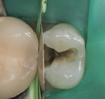 Fig 2. After removal of the existing amalgam restoration, a FenderWedge was placed.