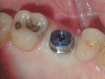 Fig 11. A stock abutment (Fig 10) was placed in the No. 14 implant site to torque (Fig 11). Note the initial tissue blanching, which was due to the difference in contour between the tissue surface of the abutment and the soft tissue.