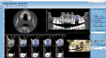 Fig 3. CBCT scan for virtual implant planning showing virtual placement of a 5.5-mm x 16-mm implant.