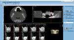 Fig 2. Post–sinus graft CBCT scan following osseous graft to add bone to the UL sinus in the No. 14 site.