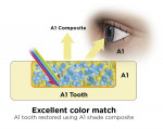 Fig 4. An A1 shaded tooth restored
with A1 shade composite offers an excellent color match (Fig 4). An A4 shaded tooth restored with A1 shade composite
provides a poor color match (Fig 5).
