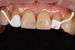 Fig 2. Lingual shelf established on teeth Nos. 8 and 9 with OMNICHROMA BLOCKER using a silicone putty index.