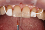Fig 3. White resin applied to teeth Nos. 8 and 9 prior to application of final layer of OMNICHROMA to create internal characterization.