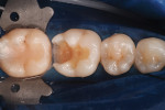 Fig 9. Preoperative view of tooth No. 19 class II cavity preparation.