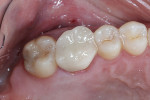 Figure 1  The patient presented with pain at the site of her left maxillary first molar, which had recently undergone endodontic retreatment and restoration with a provisional crown.