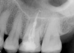 Figure 2  Radiographic examination revealed the presence of a periapical lesion and a broken file.