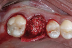 Figure 4  Xenograft granules were packed into the cleaned and disinfected extraction site.
