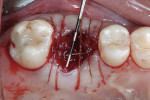 Figure 5  An OsseoGuard Flex Membrane was trimmed and positioned to cover the graft material. The membrane was tucked under the soft tissue and secured with resorbable sutures.