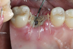 Figure 6  Healing was uneventful at 6 days after the extraction and grafting.