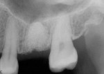 Figure 10  At 4 months postoperative, a radiograph of the graft site showed excellent containment of the graft material.