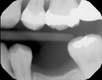Figure 2  Tooth No. 13, 6-month bitewing radiograph demonstrating radiopaque fill and appropriate proximal contours.