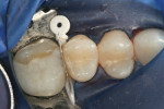 Figure 3  Tooth No. 13 was isolated with Ultradent’s DermaDam and Triodent’s WedgeGuard.